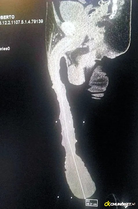 Bức ảnh X-Quang cu bự nhất thế giới cho thấy những tổn thương kinh hoàng